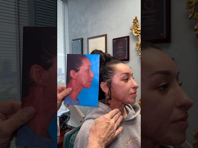 Acid Burn Survivor - The  Healing Journey Back !