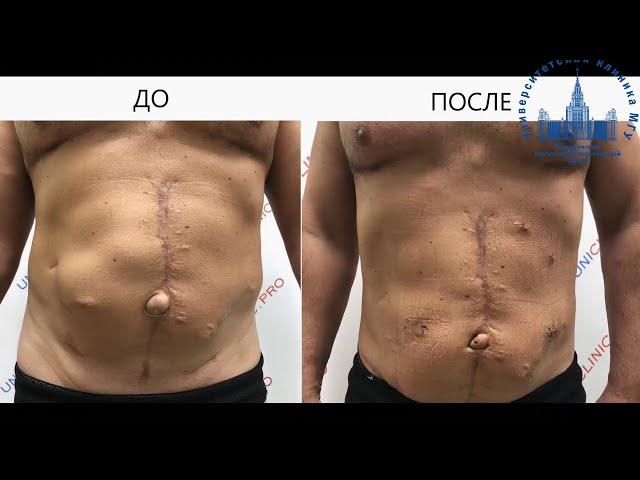 Лечение сложной послеоперационной грыжи. Лапароскопия.
