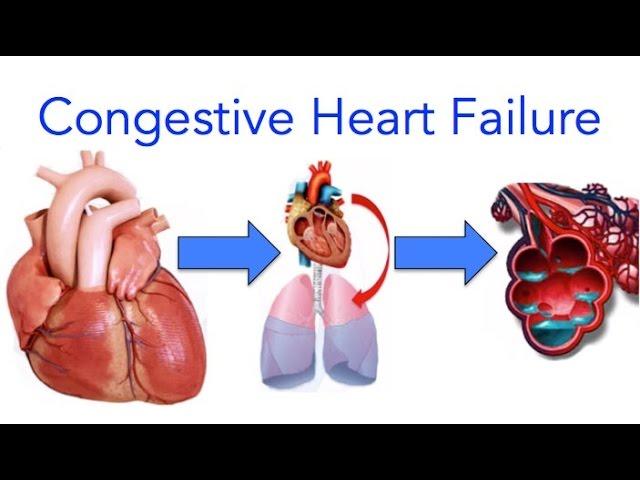 Congestive Heart Failure (CHF) Explained - MADE EASY