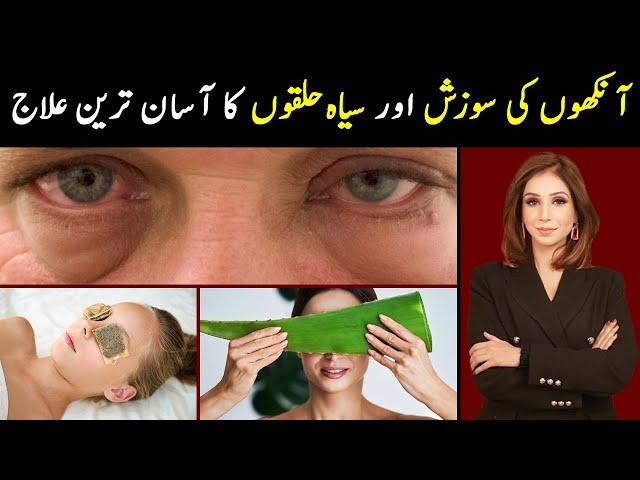 Easy Remedies for Dark Circles and Eyes Swelling | Dr Sahar Chawla