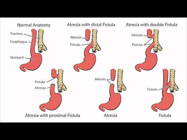 Esophageal Atresia - What is Esophageal Atresia