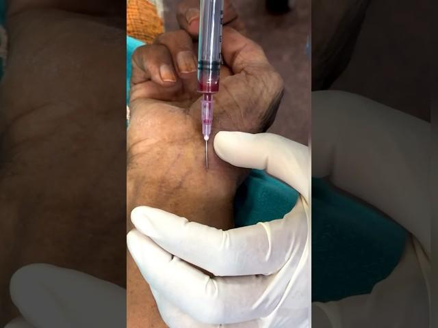ABG technique Radial artery  #norcet #nursing #knowledge #medical #abg