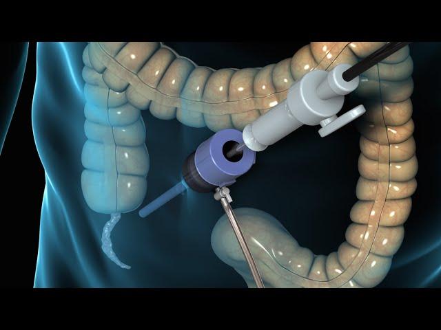 Laparoscopic Appendectomy Surgery | Nucleus Health