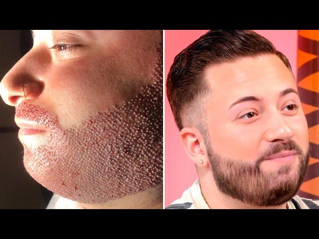 Beard transplantation in summer: Now is the perfect moment