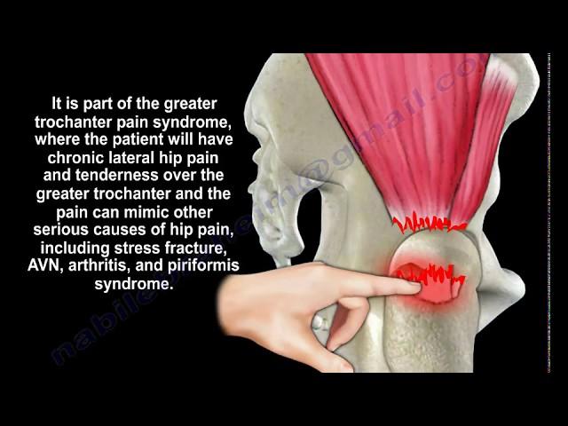 Gluteus Medius Tendon Tear  - Everything You Need To Know - Dr. Nabil Ebraheim