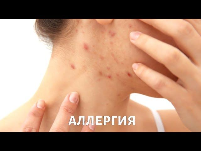 Почему возникает АЛЛЕРГИЯ и как с ней бороться?