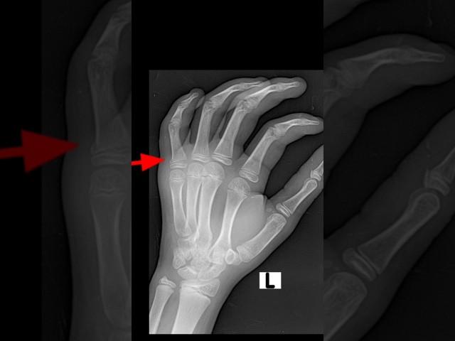 Little finger proximal phalanx fracture #xray