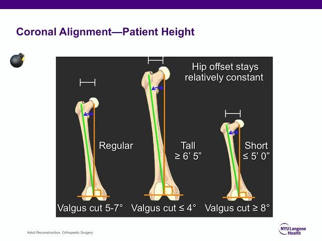 Primary Knee Replacement - ABOS Orthopedic Surgery Board Exam Review