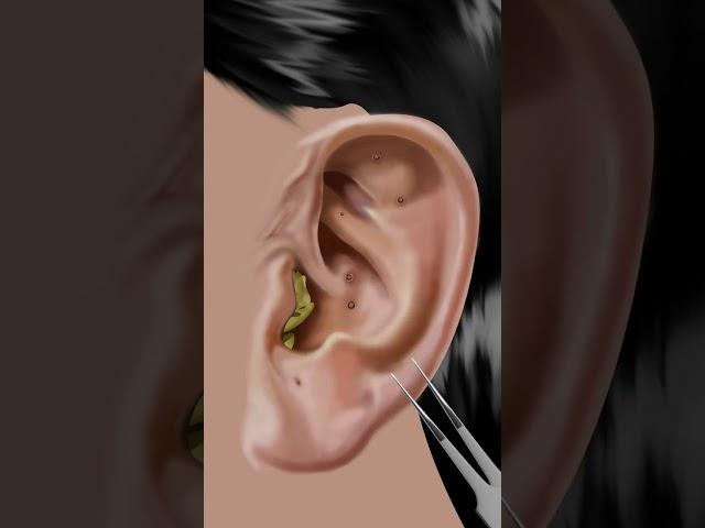 #asmr Itchy & Smelly Ear Stone Removal #animation #beauty #ear