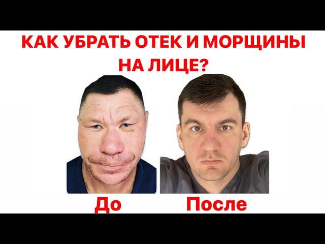 Навсегда убрал отек на лице и морщины и стал на столько красивым что женился на королеве Англии