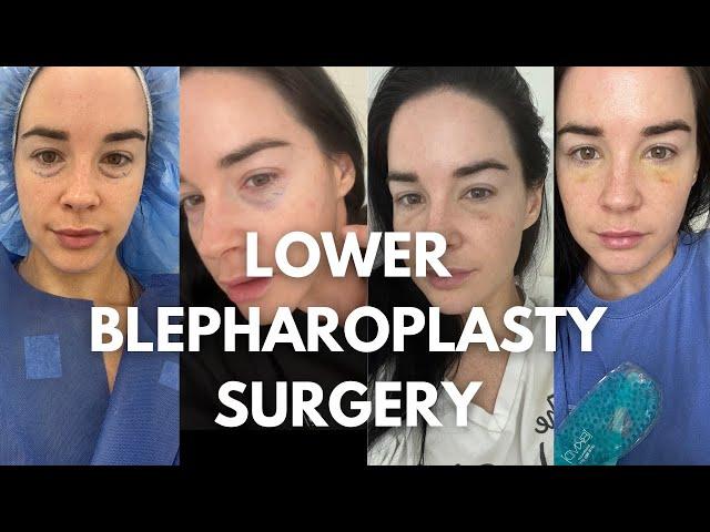 I FINALLY DID IT! GETTING A LOWER BLEPHAROPLASTY SURGERY IN NYC: cost, doctor, recovery process