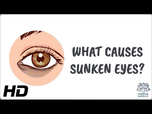 Why Do We Get Sunken Eyes? The Ultimate Guide