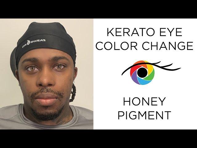 Eye Color Change from Dark to Light Brown with Kerato