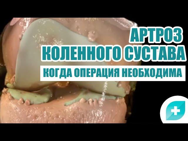 Артроз коленного сустава: когда операция необходима?