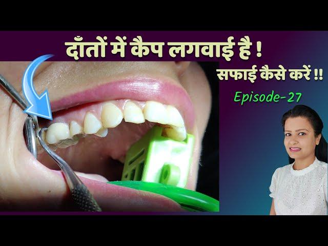 how to clean crown teeth at home |दाँतों में कैप लगवाई है,सफाई कैसे करें danto ki safai ।Episode -27