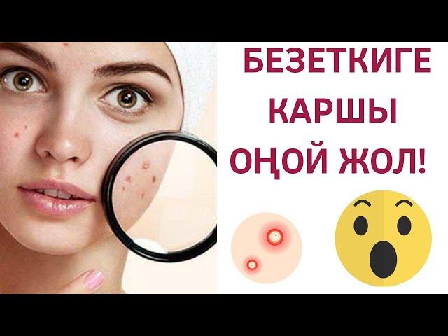 Бетке чыккан Безеткилерди (угри) кантип жок кылса болот?