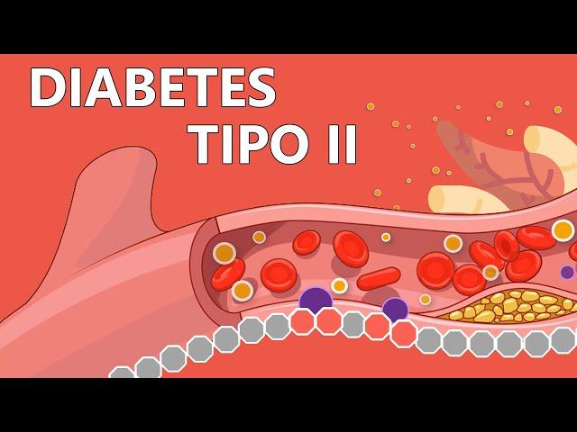 Type 2 Diabetes - Easily Explained to Patients