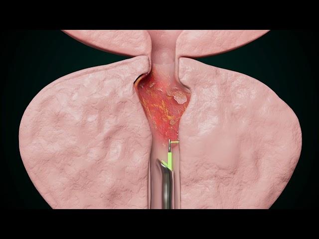 The Best Treatment for Enlarged Prostate: Prostate Artery Embolization