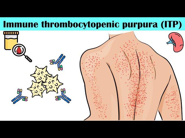 Immune Thrombocytopenic Purpura (ITP) - Causes, Pathogenesis, Signs & Symptoms, Diagnosis, Treatment