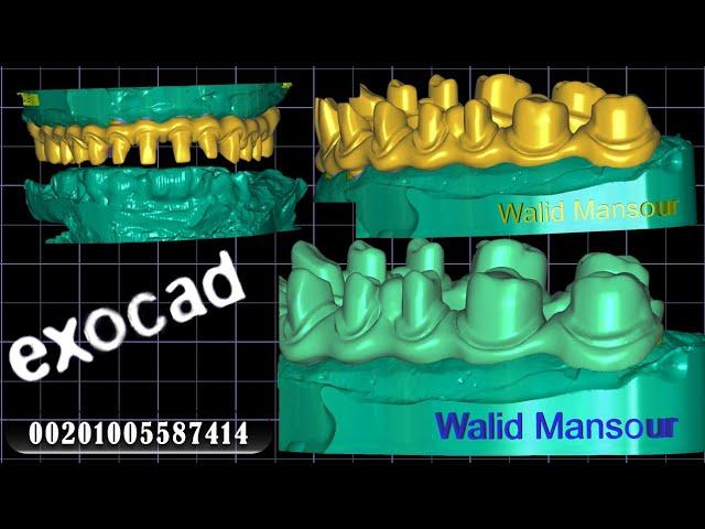 exocad freamwork peek                Walid Mansour 00201005587414 Cairo.Egypt