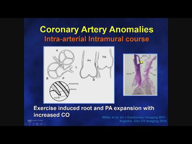 Adult Congenital Heart Disease: Anomalous Coronary Arteries (Risk Stratification)