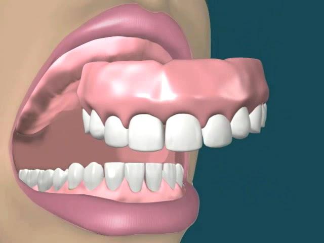 Dental Video for Upper Denture - The Tooth