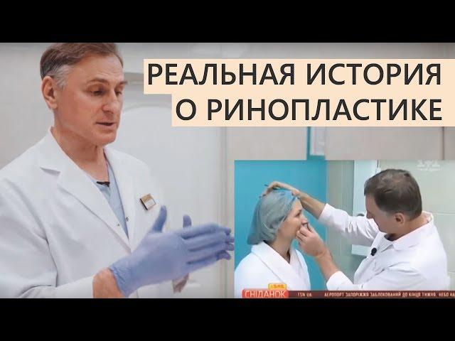 ⭐️Ринопластика  Реальная история  отзыв о пластика носа пластический хирург Павел Денищук