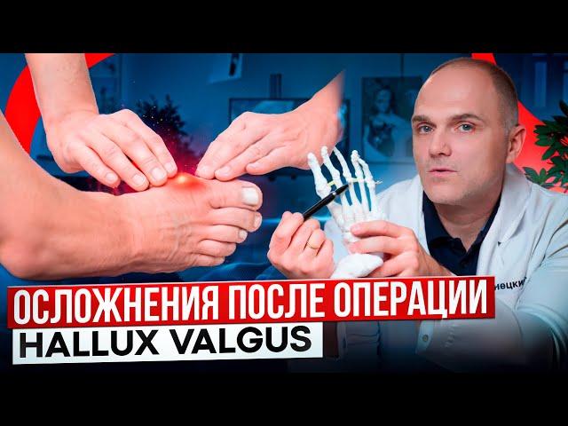 Вальгус вернется. HALLUX VALGUS: ОСЛОЖНЕНИЯ ПОСЛЕ ОПЕРАЦИИ. КАК ИХ ИЗБЕЖАТЬ. ДОКТОР БАНЕЦКИЙ.