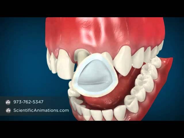 Dental Cap Procedure -- Tooth Caps
