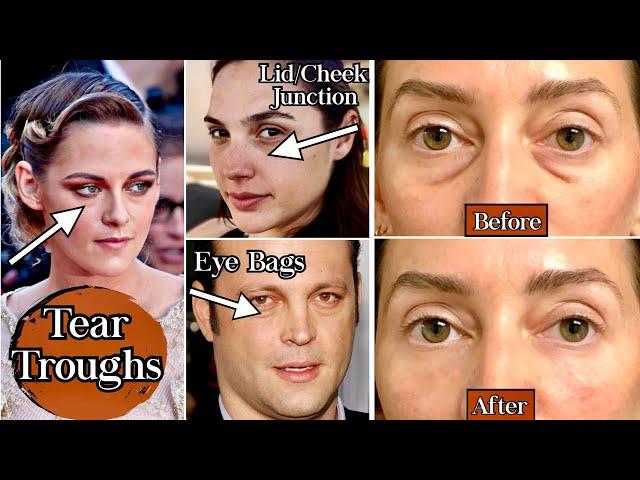 Tear Trough Filler Before and After | How Filler helps Under-Eye Darkness and Eye Bags