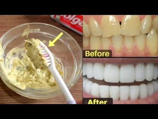 Get white teeth in just 2 minutes / How to whiten teeth in 2 minutes.