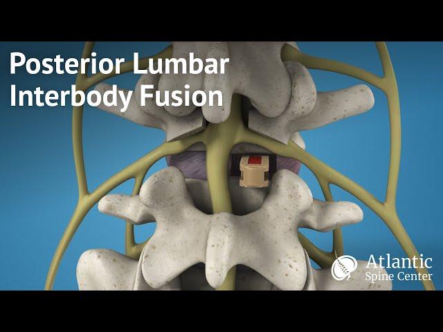 Posterior Lumbar Interbody Fusion (PLIF)