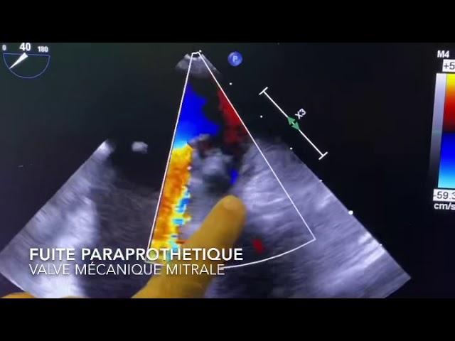 Fermeture percutanée de fuite paraprothetique