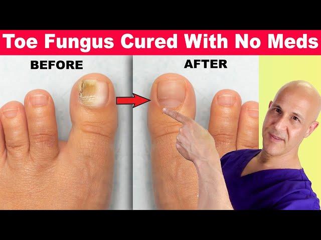 Toe Nail Fungus Cured With No Meds!  Dr. Mandell