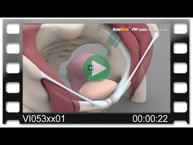 DynaMesh®-PRP - Animation: Hysteropectopexy - Posterior Fixation