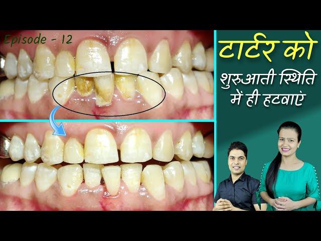 teeth cleaning tartar removal in hindi | tartar removal dentist | दांतों की सफाई  Episode - 12