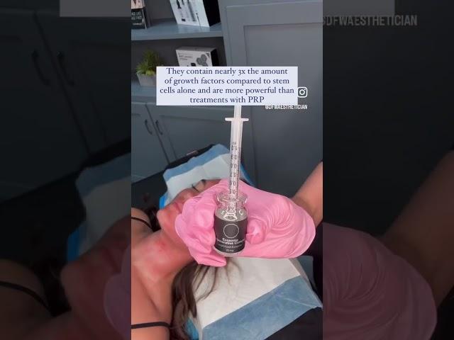 Exosomes with Microneedling