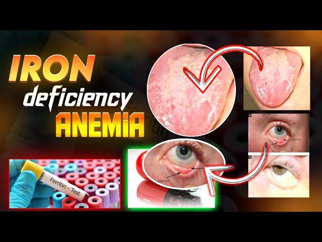 Iron deficiency anemia and chronic disease of anemia| symptoms| diagnosis and treatment