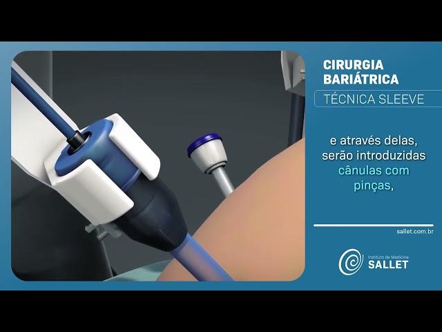 Técnica Sleeve | Cirurgia Bariátrica 3D