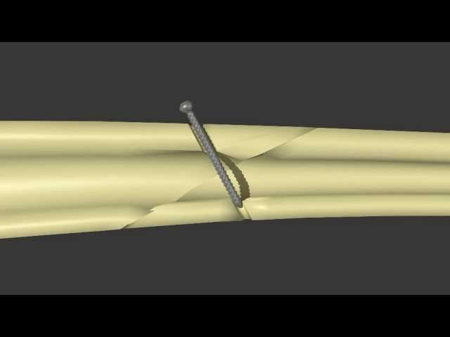 Fracture Fixation:  Lag Screw