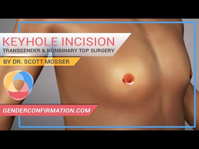 Transgender & Non-binary Keyhole Incision Top Surgery by Dr. Scott Mosser