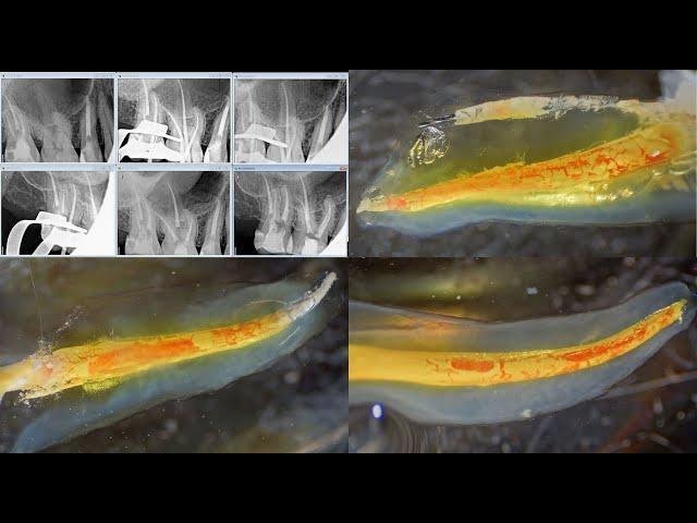 Upper first molar cleared specimen after failed RCT. 4K