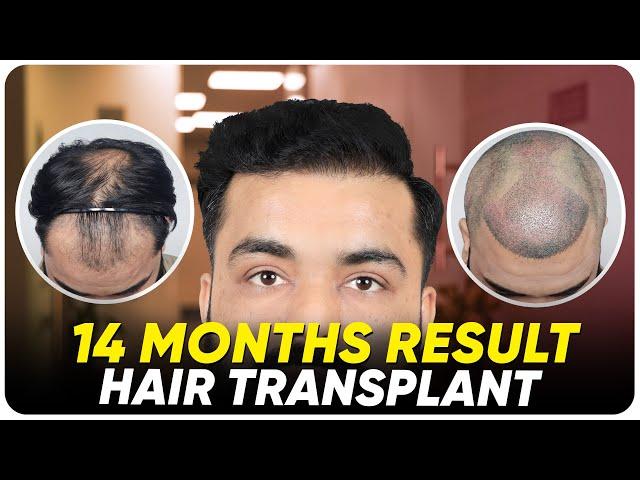 Hair Transplant in Turkey | Best Results & Cost of Hair Transplant in Turkey