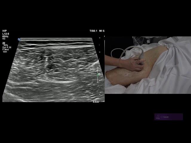 Hamstring Ultrasound of the  Semimembranosus and Semitendinosus