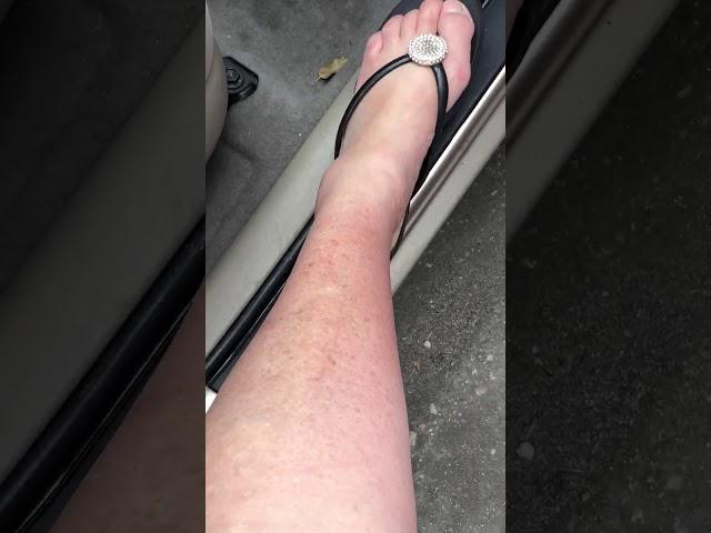 4/5/20 My legs and feet burnt while sleeping in my car