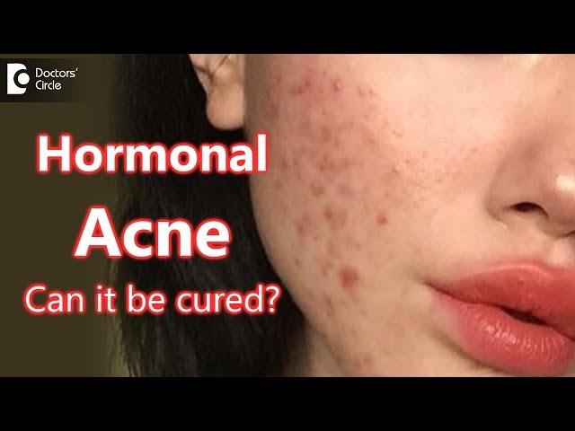 Can Hormonal Acne be cured? - Dr. Rasya Dixit