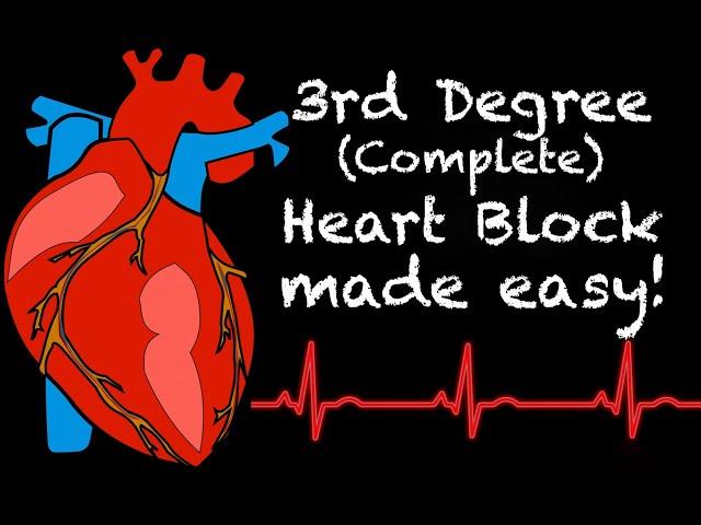 EMS Cardiology || Tachy Tuesday: 3rd Degree Heart Block (Complete Heart Block) in EMS