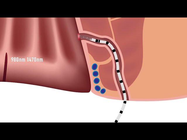 FILAC ALFA Anal Fistula - IBI Healthcare Institute