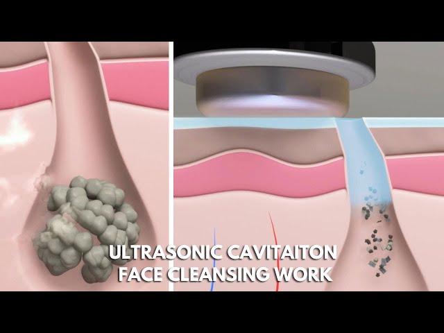 Ultrasonic Cavitation Face Cleaning | What Is Ultrasonic Cavitation Face Cleaner | myChway N7