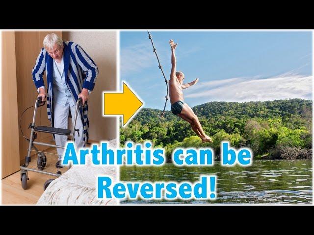 Arthritis can be Reversed!